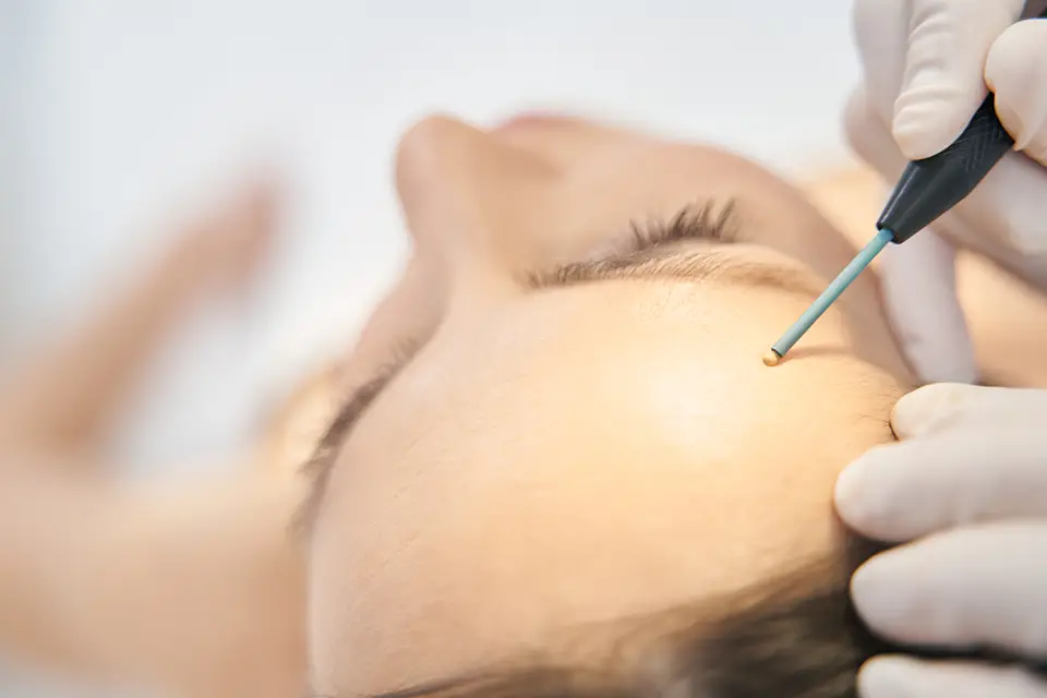 Who Is a Good Candidate for Electrolysis Hair Removal